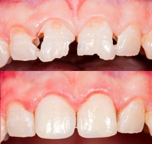 Tooth Bonding Tooth Bonding