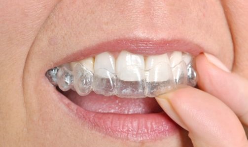 Clear Braces Clear Braces