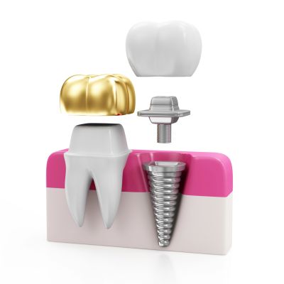 Sugar Grove dentist offers ceramic crown Sugar Grove dentist offers ceramic crown