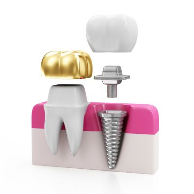 Sugar Grove dentist offers ceramic crown 