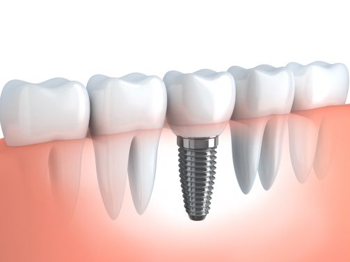Dental Implant in Sugar Grove IL Dental Implant in Sugar Grove IL