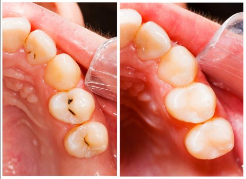 Tooth Colored Filling Tooth Colored Filling