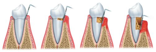 Gum Treatment in Sugar Grove Gum Treatment in Sugar Grove