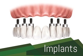 Implant Dentistry Implant Dentistry